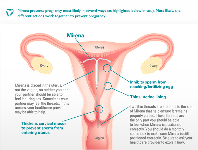 Mirena IUD